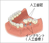 インプラント1