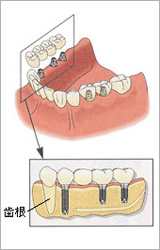 インプラント2